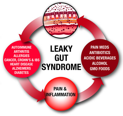 Leaky Gut Syndrome - imagine