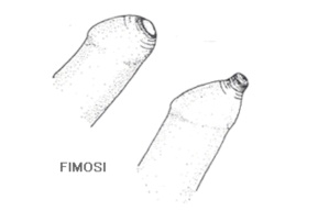 Fimosi